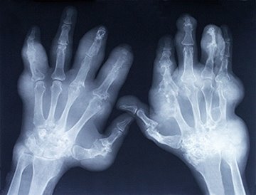 Curso on line de Artrite Idiopática Juvenil